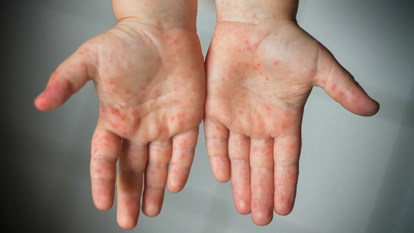 Gauteng health officials are responding to a measles outbreak, with 181 confirmed cases reported so far this year. Most cases are in Johannesburg, Tshwane, and Ekurhuleni. Image: iStock.