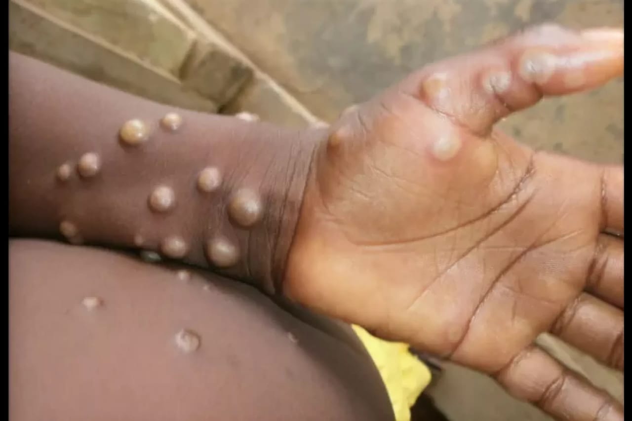 Health officials confirm a new mpox case in Cape Town as vaccination efforts increase in high-risk provinces. Image: UNICEF Uganda.
